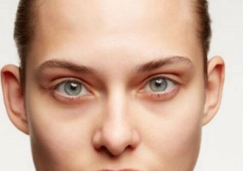 UNDER EYE DARK CIRCLES