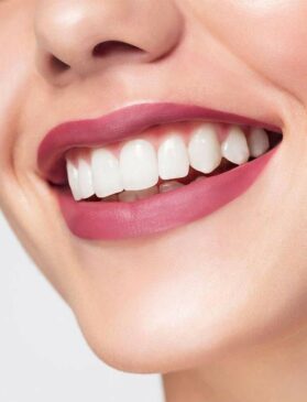 VENEERS3